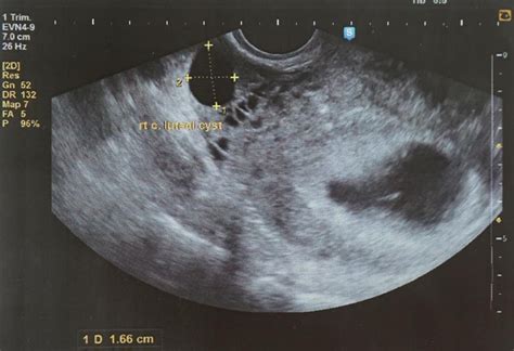 5 Weeks Pregnant Ultrasound Scan