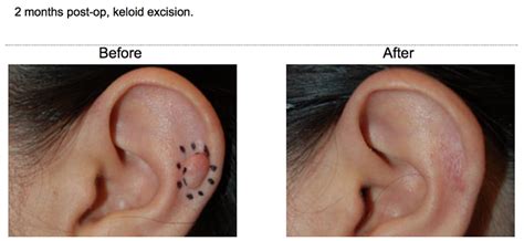 Keloid Removal ⋆ Fresno Plastic Surgery