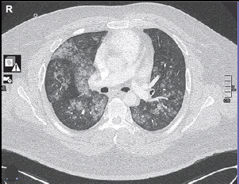 Diffuse Alveolar Hemorrhage. 33-year-old male with dyspnea and ...