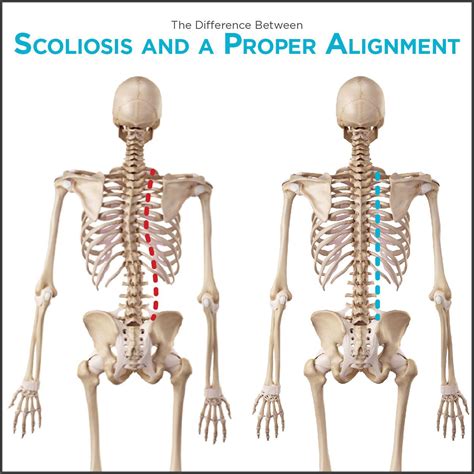 Pin on Back Injuries & Spine Disorders | What's Causing my Back Pain ...