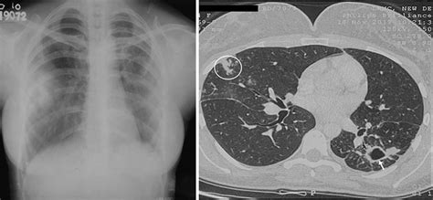 Chest radiograph in a 29 yr old female patient with Mycobacterium ...