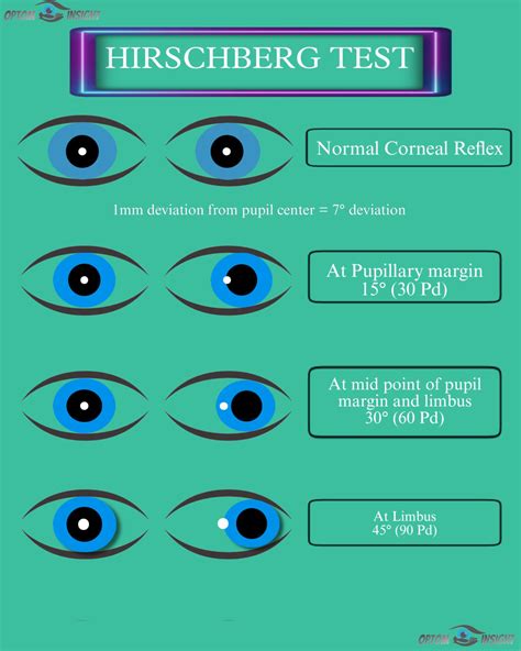 Hirschberg test - OptomInSight
