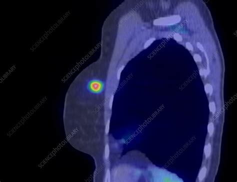 Breast cancer, CT and PET scan - Stock Image - C016/6767 - Science ...