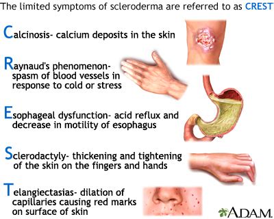 CREST syndrome: MedlinePlus Medical Encyclopedia Image