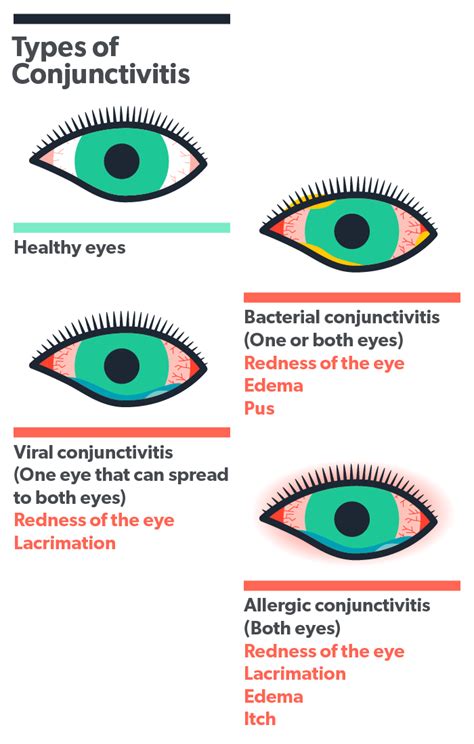 Allergic Conjunctivitis - Cohen Laser & Vision Center