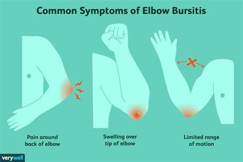 Elbow Bursitis: Symptoms, Causes, and Treatment