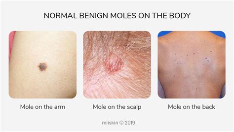 About Moles - Types, Warning Signs, Causes, and Prevention