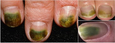 Nail Signs Green nail syndrome 绿甲综合征 - TANGS CLINICAL TCM