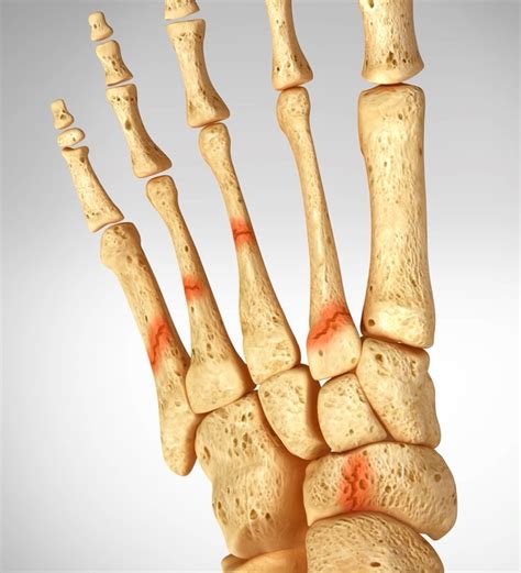 Metatarsal Stress Fracture: Causes - SLO Motion ShoesSLO Motion Shoes