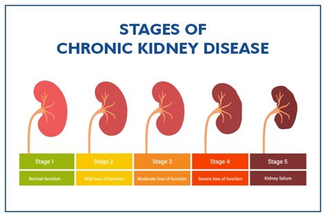 Kidney Failure End-Stage Renal Disease: Symptoms, Causes, 55% OFF