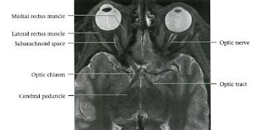 Dr Balaji Anvekar FRCR: Cranial Nerves Normal MRI Anatomy