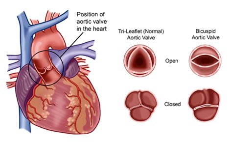 Normal Aortic Valve