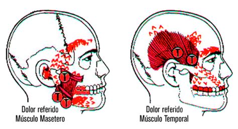 dolores-referidos-musculos-masetero-y-temporal - Clínica Baldor