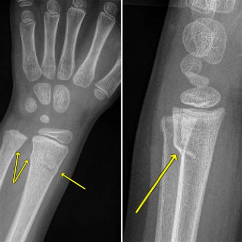 Greenstick Fracture X Ray