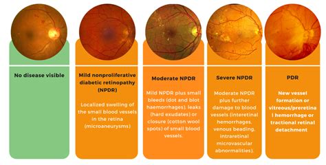 Diabetic Retinopathy – Causes, Symptoms, Risks & Prevention - Vision ...