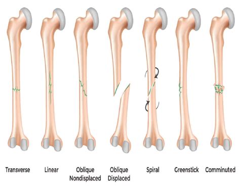 Greenstick Fracture: 3 Types, Causes, Risk Factors, Symptoms, Diagnosis ...