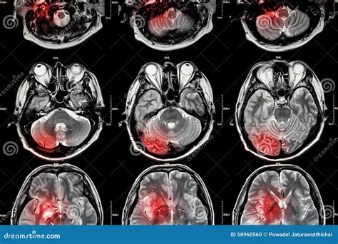 Film MRI ( Magnetic Resonance Imaging ) Of Brain ( Stroke , Brain Tumor ...