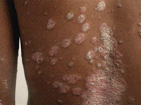 Rash on black skin: Pictures, symptoms, and treatments