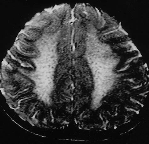 Leukodystrophy in Children: A Pictorial Review of MR Imaging Features ...