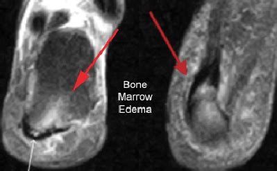 Patella Bone Marrow Edema