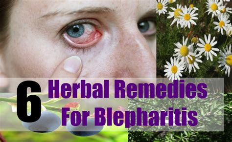 6 Herbal Remedies For Blepharitis – Natural Home Remedies & Supplements