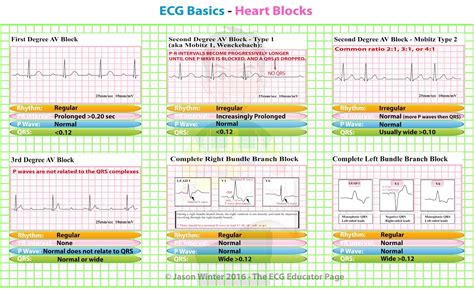 ECG Educator Blog : Heart Blocks