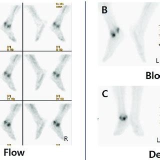 Images of three phase bone scan. A) The flow phase shows increased ...