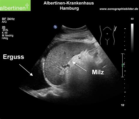 Pleural Effusion On Ultrasound