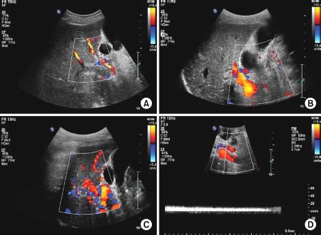 Liver Doppler ultrasound. (A) The image shows the thrombus in the ...