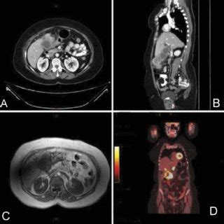 (A) CT scan -axial view at the time of diagnosis and after PTC ...