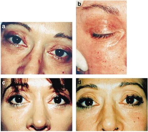 Periorbital hyperpigmentation. (a) Pretreatment. (b) Immediately after ...