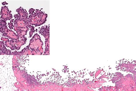 Malignant Mesothelioma: Symptoms and Treatments | Live Science