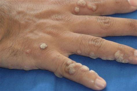 Everything You Need to Know About Warts - Med Warts