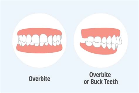 Overbite Vs Normal Bite: Differences, Causes, And Treatment, 41% OFF