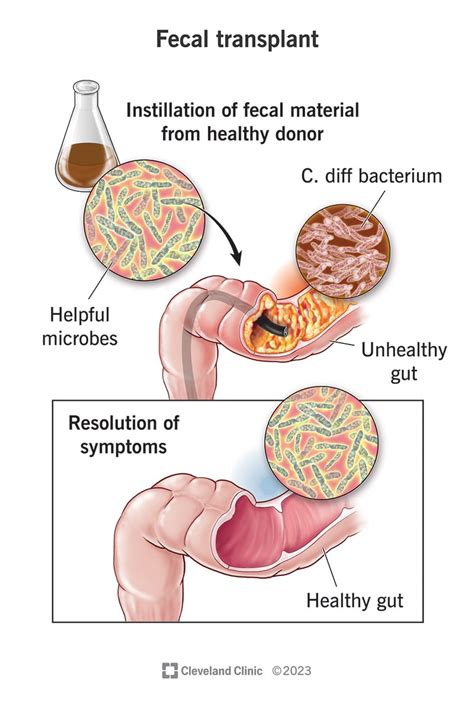 Fecal Transplant: What It Is, What It Treats, Procedure & Risks