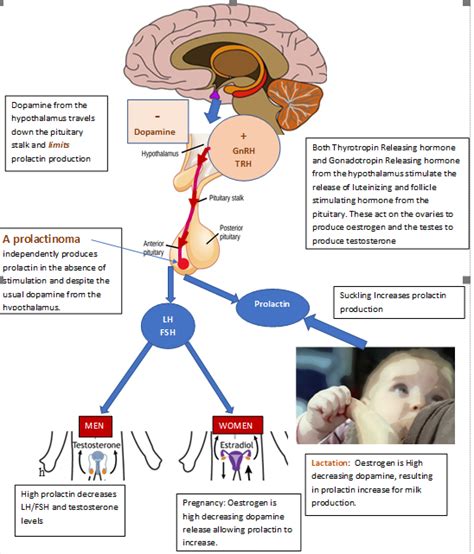 Prolactinoma - WAPO