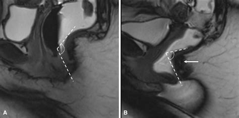 Pelvic floor dyssynergia. Sagittal balanced gradient echo images at ...