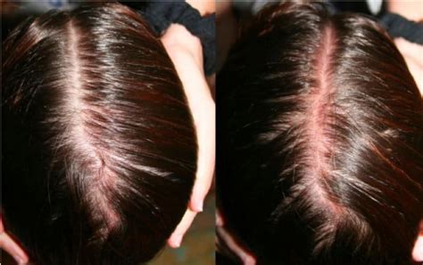 RED SCALP DISEASE - Studio Tricologico Fenice