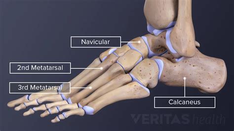 Metatarsal Stress Fracture