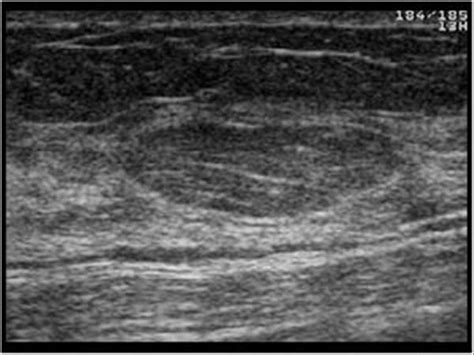 Breast and Axilla | 5.1 Benign lesions : Case 5.1.7 Lipomas ...