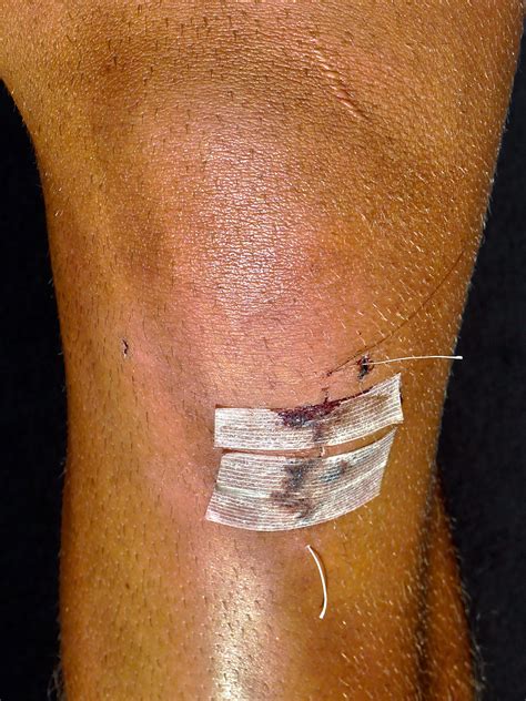 Knee surgery 5 days post-op by IvanAndreevich on DeviantArt