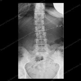 Degenerative Scoliosis: An Overview