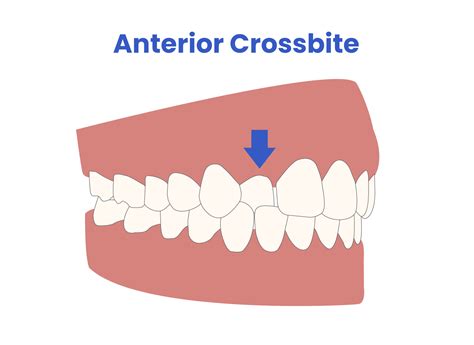 Anterior Crossbite Treatment with Clear Aligners: Case Study