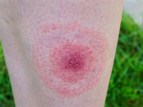 Lyme disease rash: Symptoms, stages, and identification