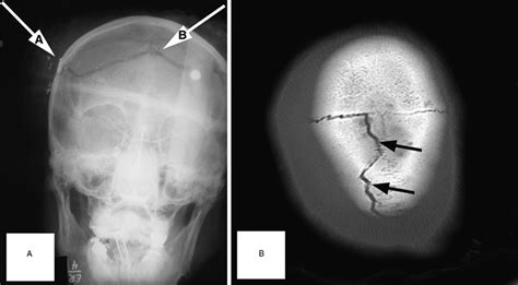 Linear Skull Fracture