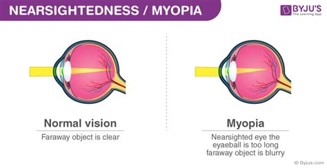 Myopia Causes, Symptoms, Formula And Nearsightedness