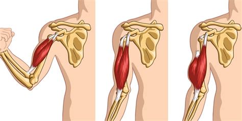 Torn Biceps: Prevention and Treatment