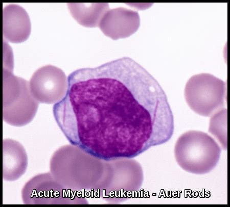 Acute Myeloid Leukemia - Ask Hematologist | Understand Hematology