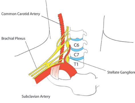 Stellate Ganglion Block : WFSA - Resources