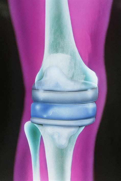 Prosthetic Knee Photograph by Chris Bjornberg | Fine Art America